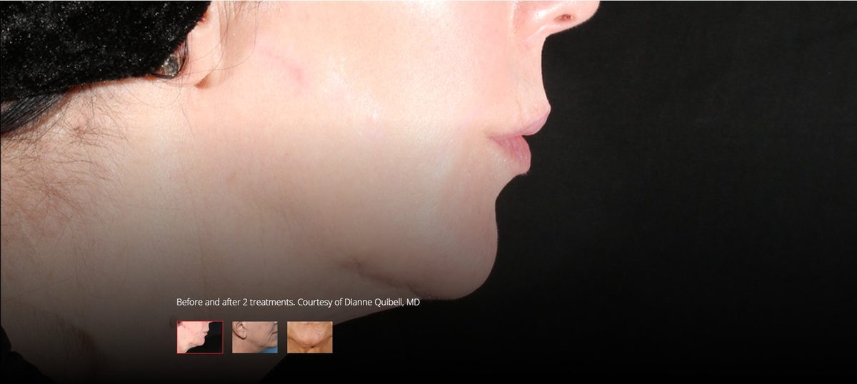 After XERF treatment