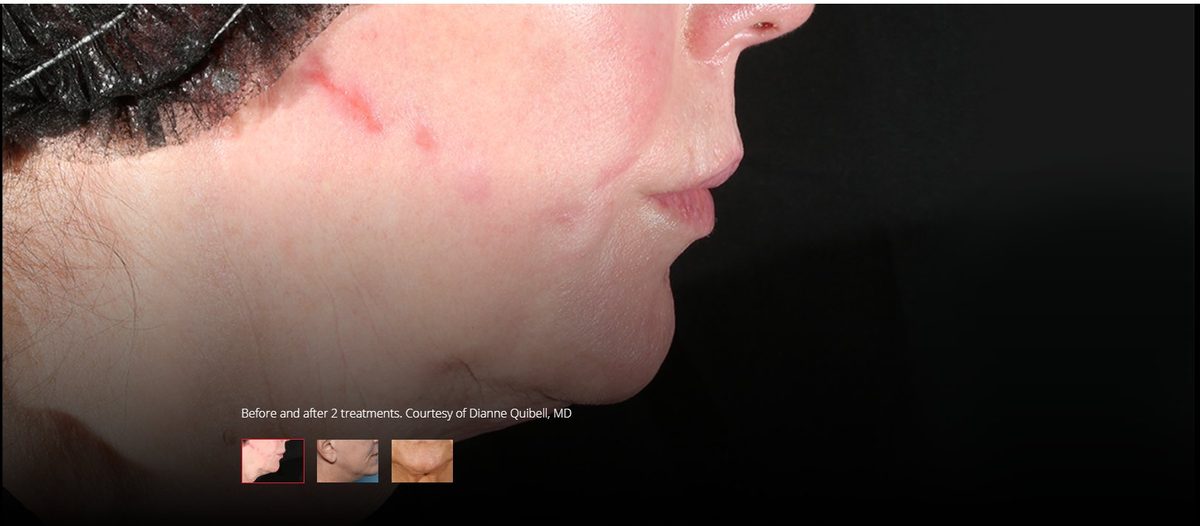 Before XERF treatment